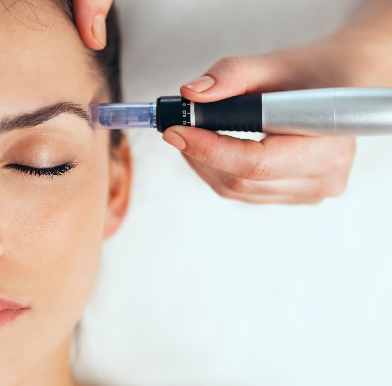 Tratamiento despigmentante con Dermapen (4 sesiones) + 1 Serum despigmentante